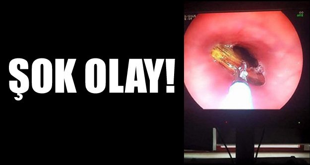 20 SANTİMLİK ÖYLE BİR ŞEY YUTTU Kİ!