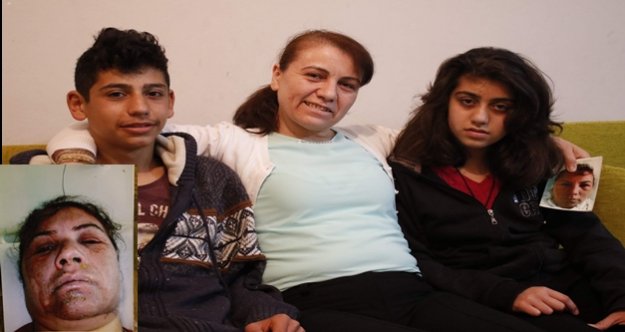 KOCASI TARAFINDAN YAKILDI AMA O HAYATA DÖNDÜ