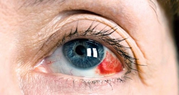 Uzmanlardan göz tansiyonu uyarısı!