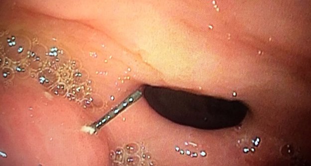 Petek bal yedi, midesinden 10 santim tel çıktı