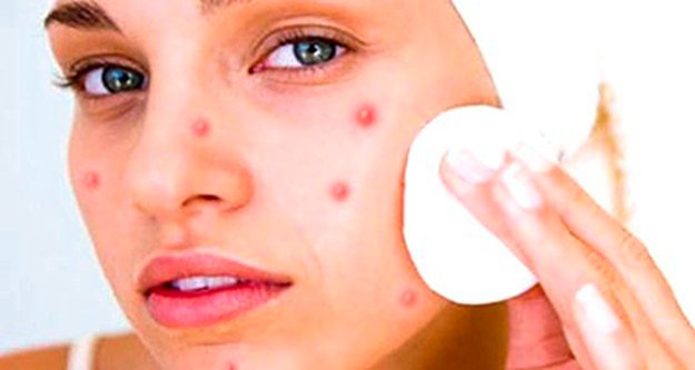 Yorgunluk ve stres sivilce problemine sebep oluyor