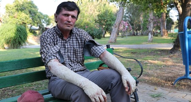 23 yıldır sedef hastalığıyla mücadele ediyor