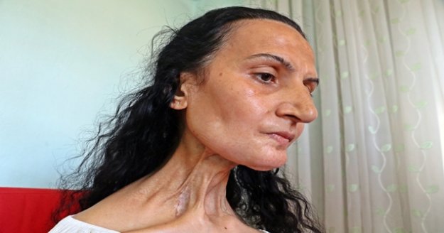 Dil kanserine yakalandı, hayatları karardı