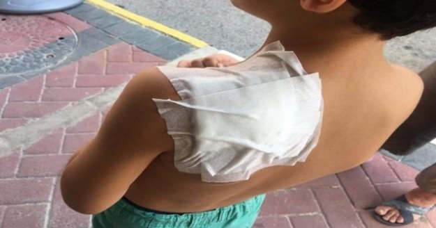 İlkokul öğrencisi, okul dönüşü sokak kopeğinin saldırısına uğradı