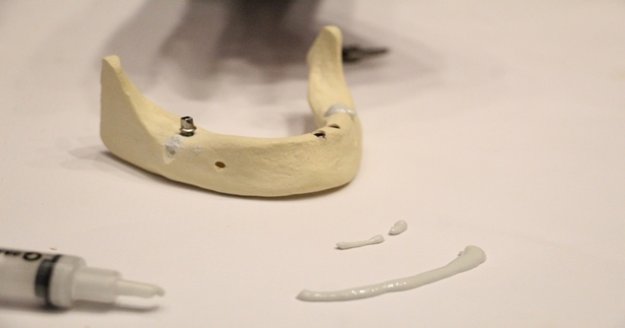 Kırık kemiklere sentetik kemik dolgusu ile 10 dakikada tedavi imkanı