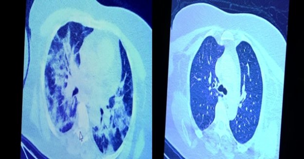 İlaç kullanan korona hastaları ile kullanmayanlar arasındaki inanılmaz fark