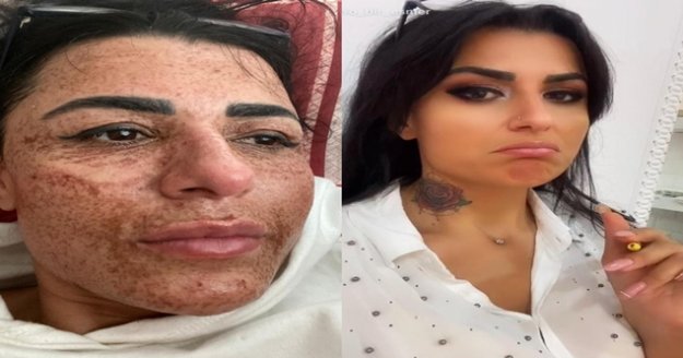 Güzelleşmek isterken yüzünde yanıklar oluşan kadın: "Gelin adaylarını görünce insanın psikolojisi bozuluyor"