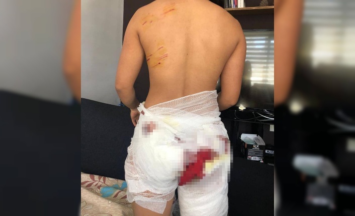 Antalya'da sokak köpeklerinin saldırısına uğrayan Endonezyalı kadın ağır yaralandı