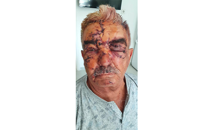 Beslediği komşusunun köpeğinin saldırısına uğradı