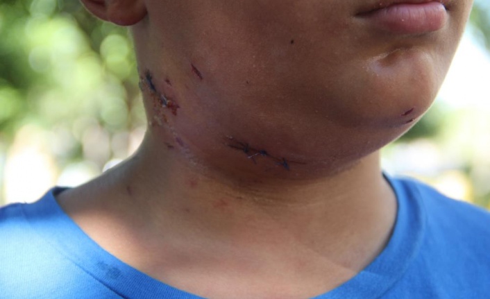 Köpek saldırısına uğrayan 10 yaşındaki çocuk ölümden döndü