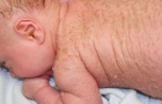 Balık Pulu hastalarına müjde