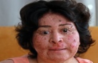 Artık telefondaki filtreler bile yüzü için yetersiz...