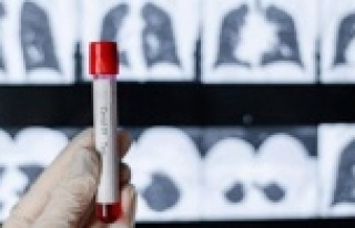 Covid-19 sonrası akciğerlerde kalıcı hasar endişesi