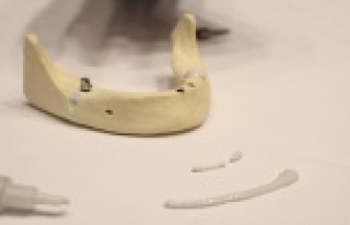 Kırık kemiklere sentetik kemik dolgusu ile 10 dakikada...