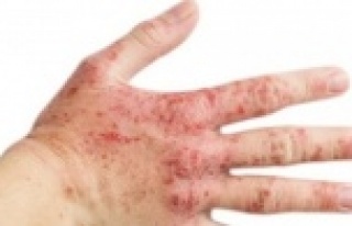 Sizde de bu belirtiler varsa, Rozasea olabilirsiniz