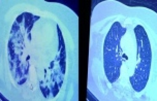 İlaç kullanan korona hastaları ile kullanmayanlar...