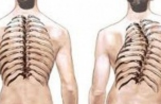 "Skolyoz, kız çocuklarda erkek çocuklara göre...