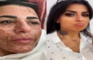 Güzelleşmek isterken yüzünde yanıklar oluşan...