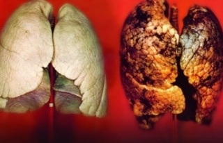 Sigara içmek akciğer sertleşmesinde başrol oynuyor