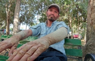 Hastalığına alıştı, insanların kendisinden...