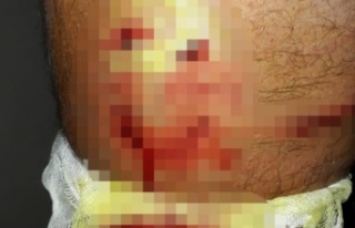 Yürüyüş yaparken sokak köpeklerinin saldırısına...