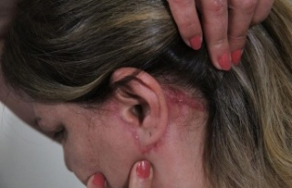 Güzelleşmeye gitti, estetik mağduru oldu