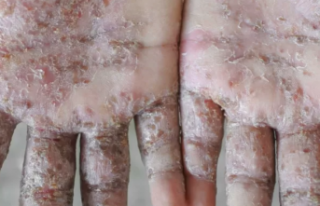 Alanya’da korona ve uyuz paniği yaşanıyor